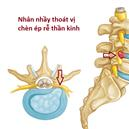 THOÁT VỊ ĐĨA ĐỆM CỘT SỐNG THẮT LƯNG: Nguyên nhân, dấu hiệu nhận biết và khi nào cần đi khám bác sĩ ?
